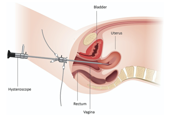 Hysteroscopy Medical Drawing of female anatomy. Hysteroscopy is a procedure that enables an internal examination of the uterus (womb) with a telescopic camera. 