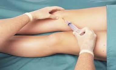 Fluid being removed from a persons' knee by syringe