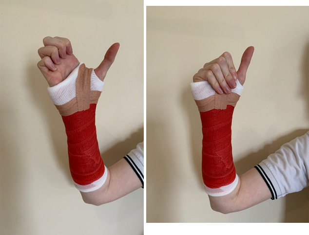 A hand in a cast with fingers touching the top of the palm and then the bottom of the palm.