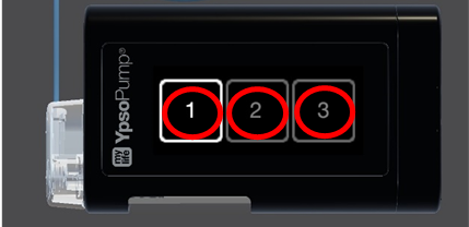 Photo of a Ypsomed MyLife CamAPS pump screen with three red circles showing 1,2,3