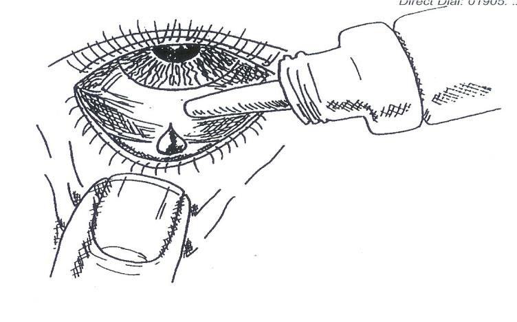 Picture of an eye looking up to the ceiling, while the lower lid is gently pulled down. an upturned dropper bottle is squeezed to put one drop into the eye