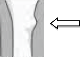 Image of wrist with bump indicating buckle fracture 