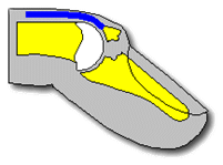 A drawing of the tip of a finger showing the tendon pulled away from the end of the bone