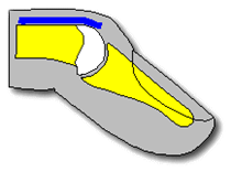 A drawing of the tip of a finger showing the tendon has ruptured