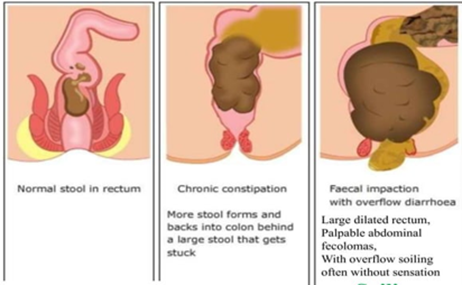 A diagram showing the normal stool and two complications of constipation