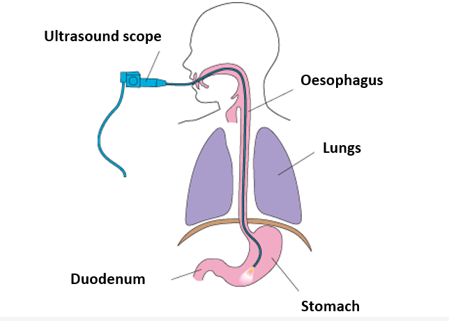 A drawing of where the ultrasound scope tube goes inside the body via the mouth