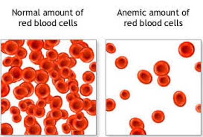 An image of two types of red blood cells. On the left side is normal amount of red blood cells. On the right side is anemic amount of red blood cells.