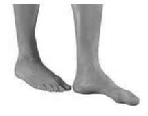 A picture of a person in a standing position with the foot fully in front of the other